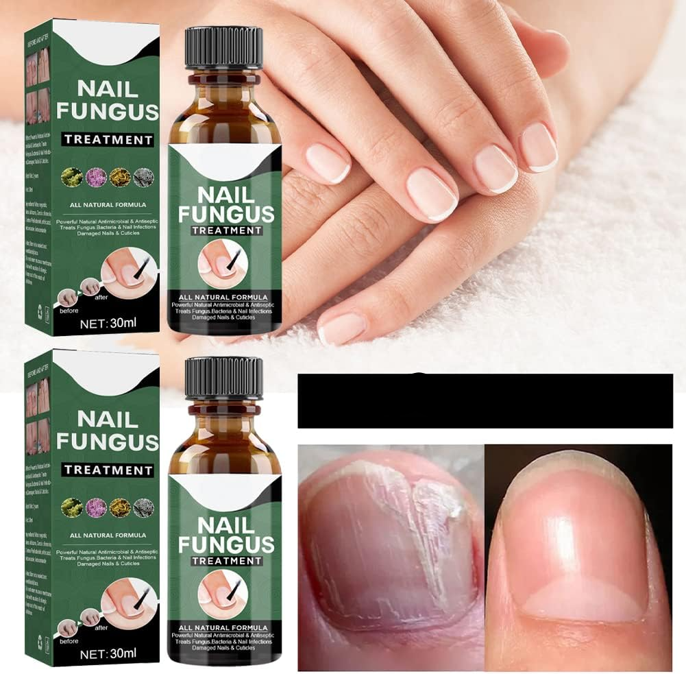 🔥This week's hot sale🔥repair nail fungus treatment serum