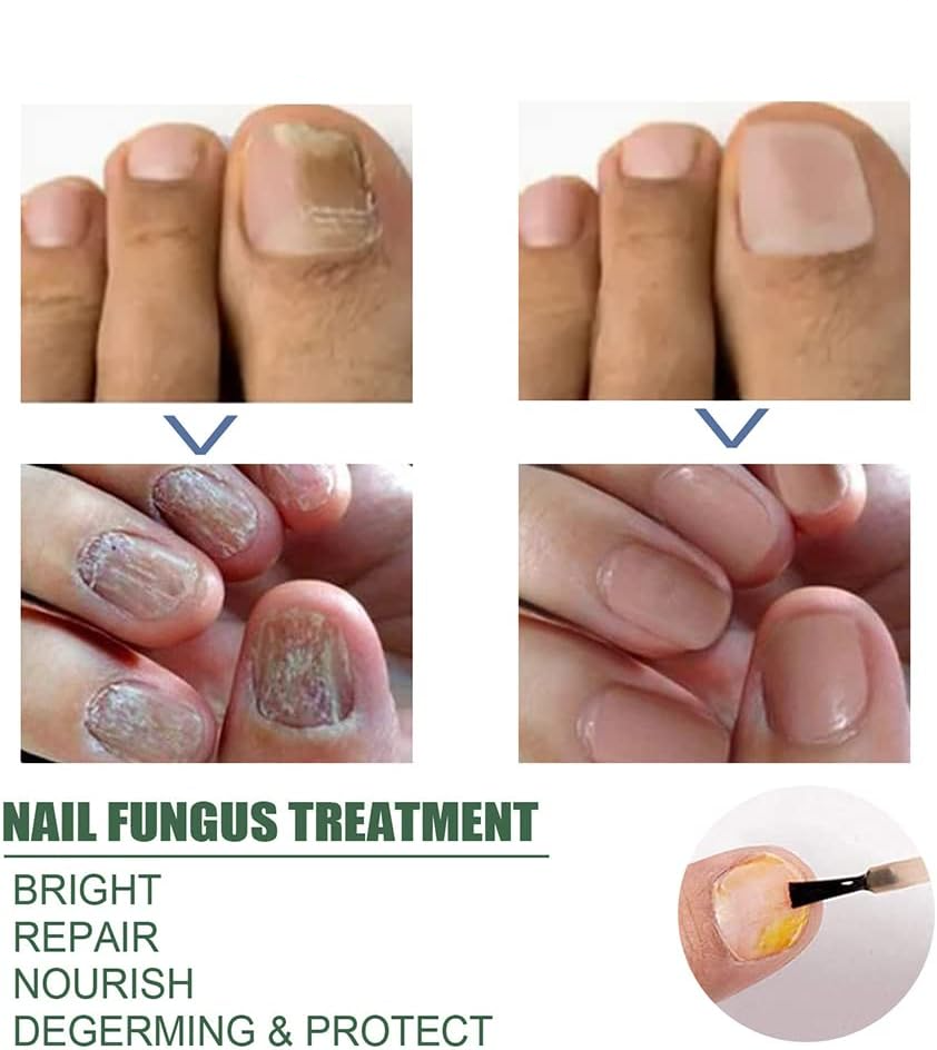 🔥This week's hot sale🔥repair nail fungus treatment serum
