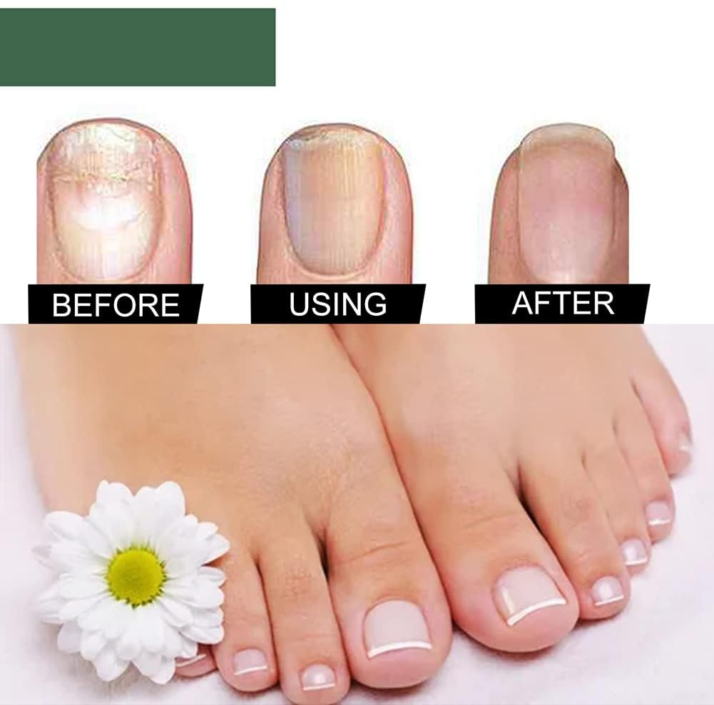 🔥This week's hot sale🔥repair nail fungus treatment serum