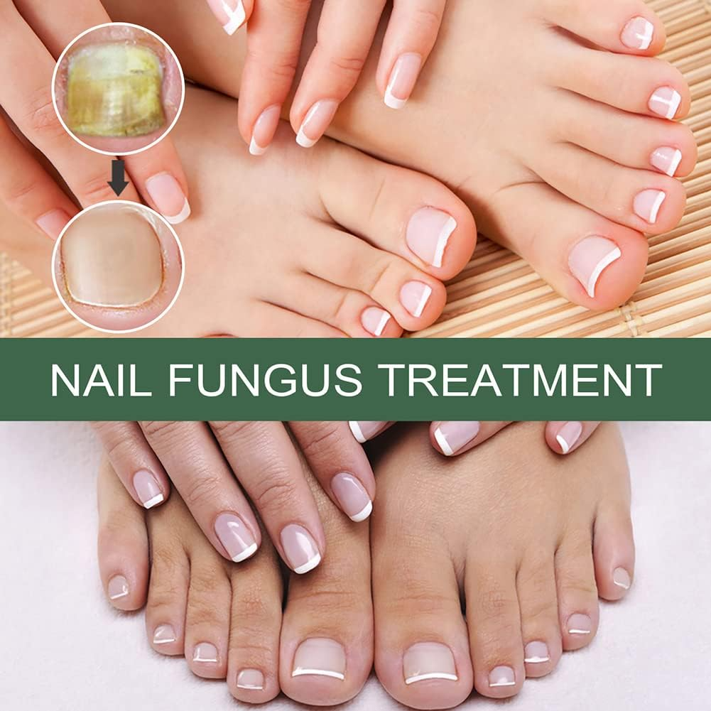 🔥This week's hot sale🔥repair nail fungus treatment serum