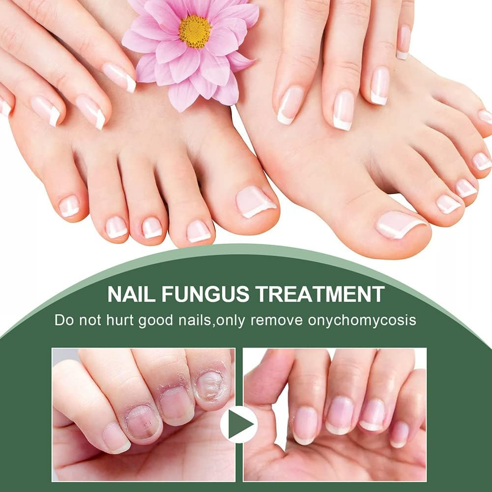 🔥This week's hot sale🔥repair nail fungus treatment serum
