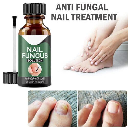 🔥This week's hot sale🔥repair nail fungus treatment serum